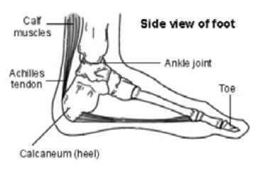 Achilles Tendinopathy Diagram
