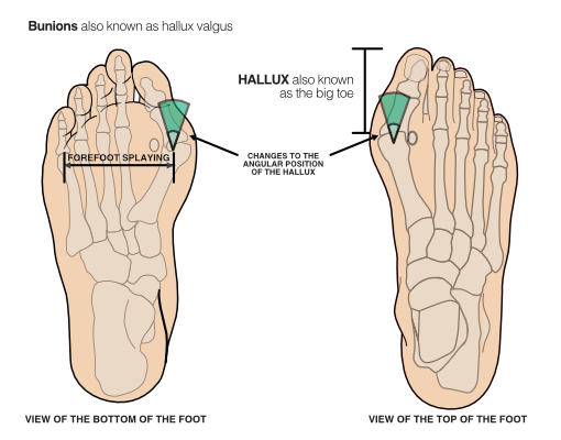 Diagram showing hallux valgus (bunions), with illustrations of the top and bottom of the foot highlighting forefoot splaying and the big toe angling inwards.