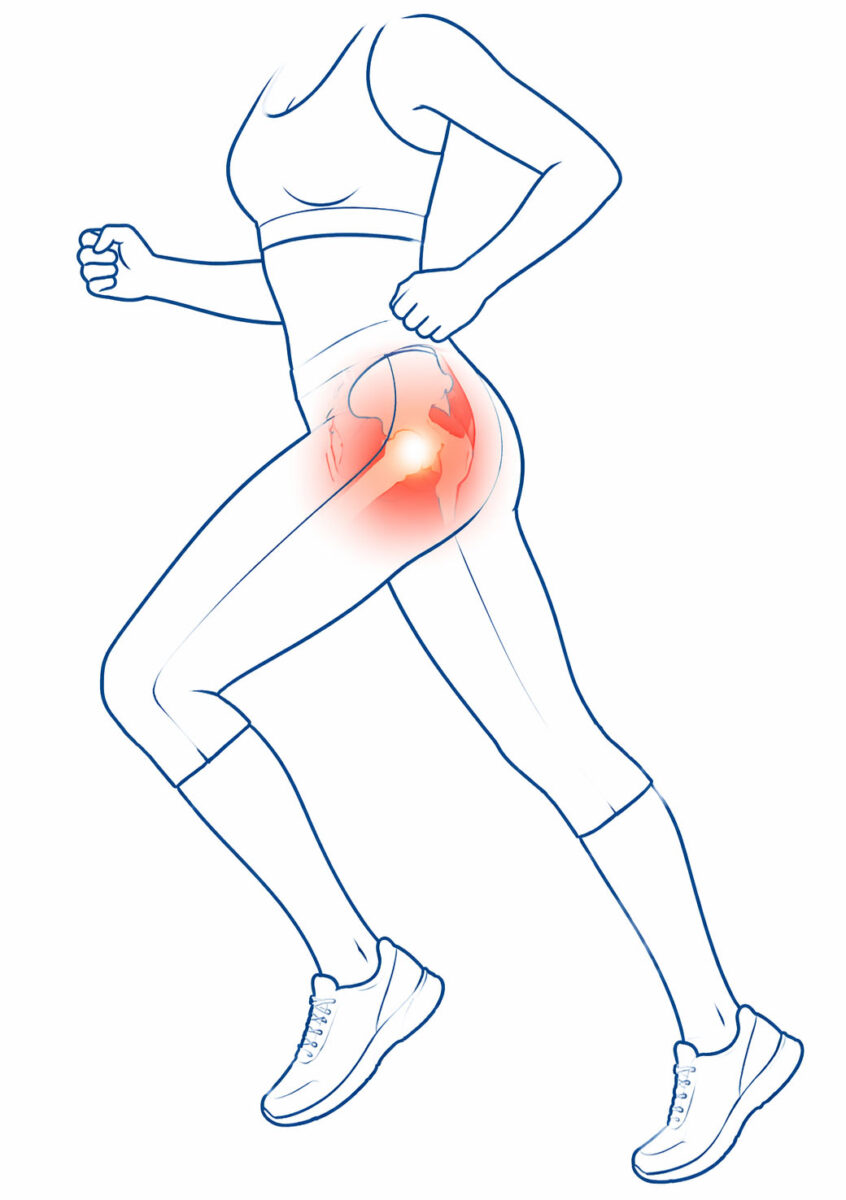 Greater Trochanteric Pain Syndrome