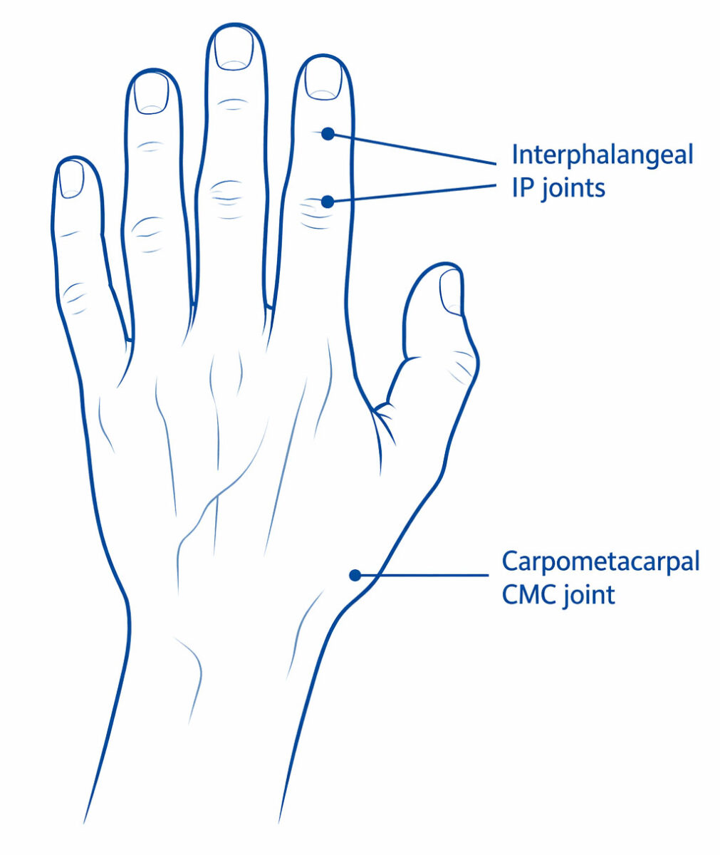 Hand Osteoarthritis