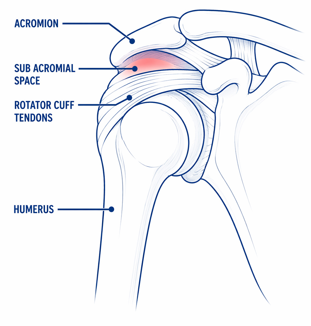 Sub Acromial Pain