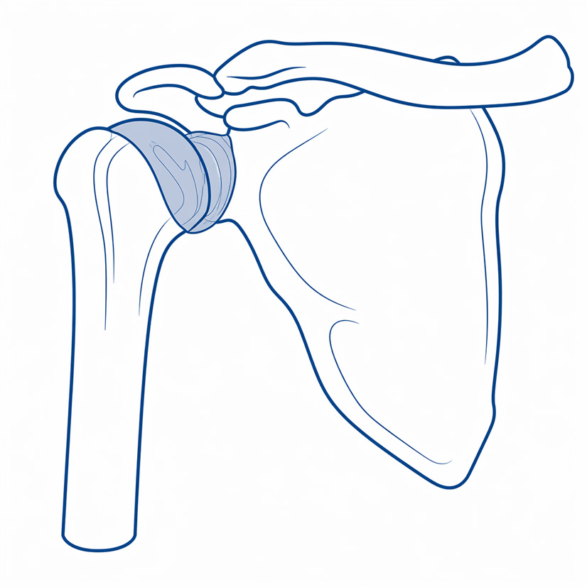 Thickened Shoulder Capsule