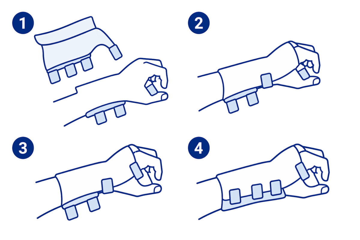 Removing and fitting a working wrist splint