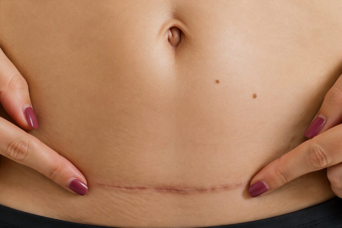 Caesarean section wound with normal healing