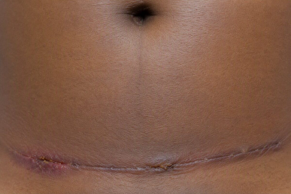 Caesarean section wound with signs of infection